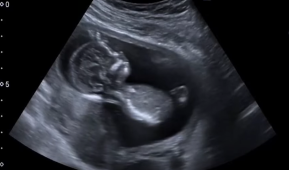 Ultrasound Daily Cases Screengrab via Youtube 825